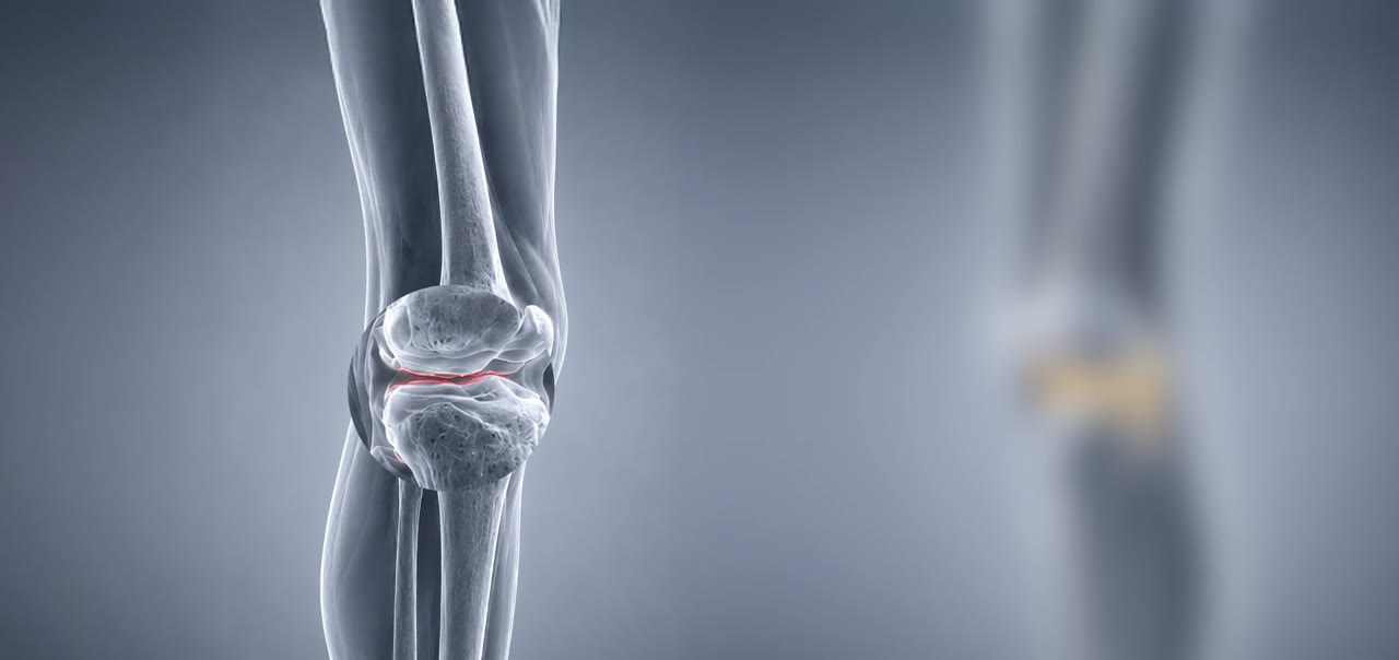 A knee joint with the bones almost touching: bone on bone